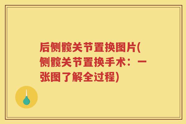 后侧髋关节置换图片(侧髋关节置换手术:一张图了解全过程) 后侧髋关节置换图片(侧髋关节置换手术:一张图了解全过程)